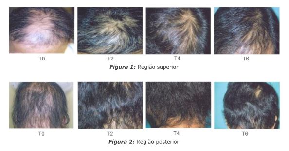 Controle da queda do cabelo usando Biosil